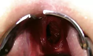 डबल गुदा मुठ्ठी, प्र ...